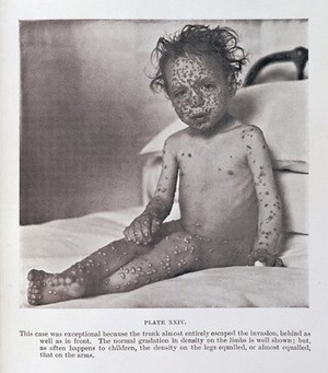 view Child with Smallpox