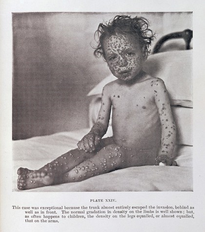 Child with Smallpox