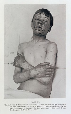 view smallpox on the face and arms of a boy