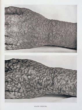 Eruption of smallpox on hand