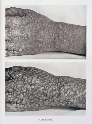 view Eruption of smallpox on hand