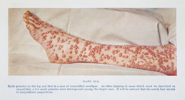 Early pustules of smallpox