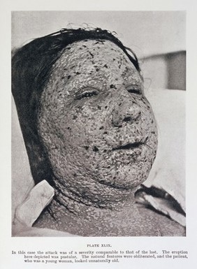 Pustular eruption of smallpox on face