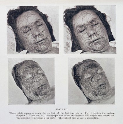 Pustular eruption of smallpox on face