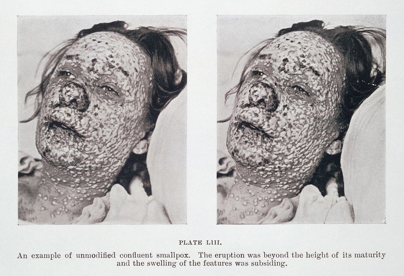 Pustular eruption of smallpox on face | Wellcome Collection