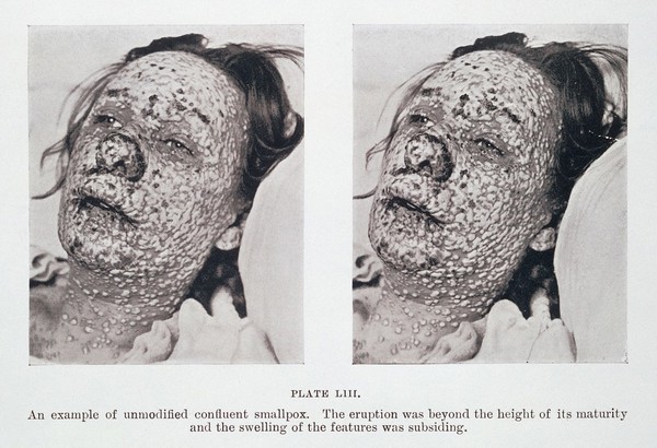 Pustular eruption of smallpox on face