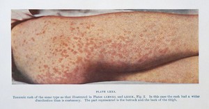 view Toxaemic rash of smallpox