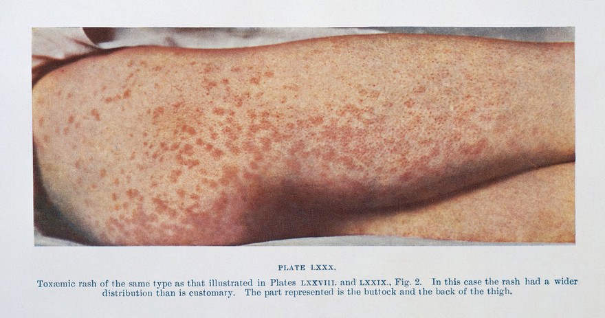 Toxaemic rash of smallpox