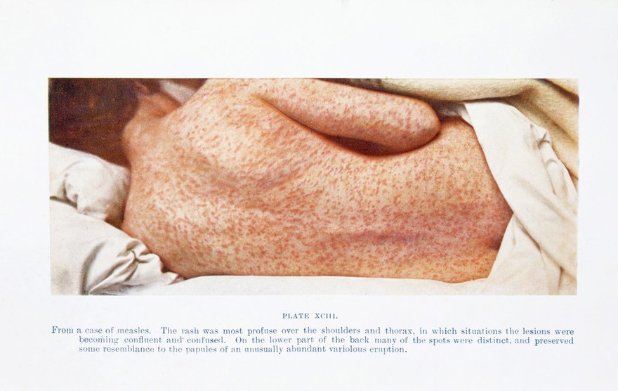 Back of female with measles