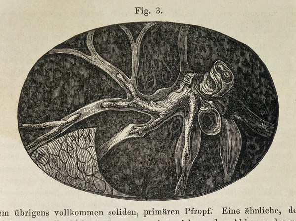 Embolus of the Lung Arteries