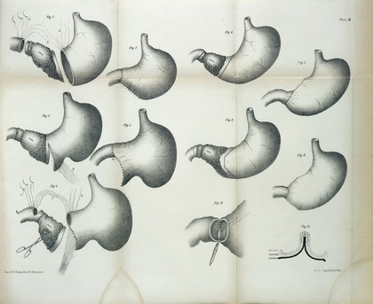 Successive phases of resection of stomach.