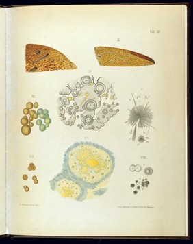 Acute Atrophy of the Liver. Leucine and Tyrosine from the Secretions.