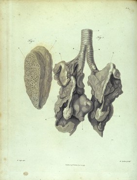 Section of diseased lung and ossification of lung