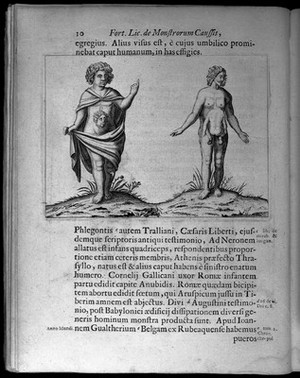 view Two human figures showing abnormalities, one with a face on the torso and the other with the body of a child on the torso