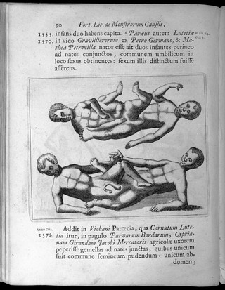 Two human figures with abnormalities