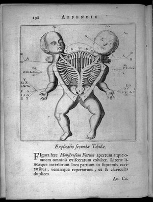 view A diagram of a Siamese twin with conjoined spine