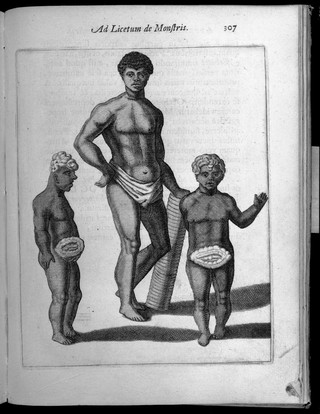 Three human figures with abnormalities
