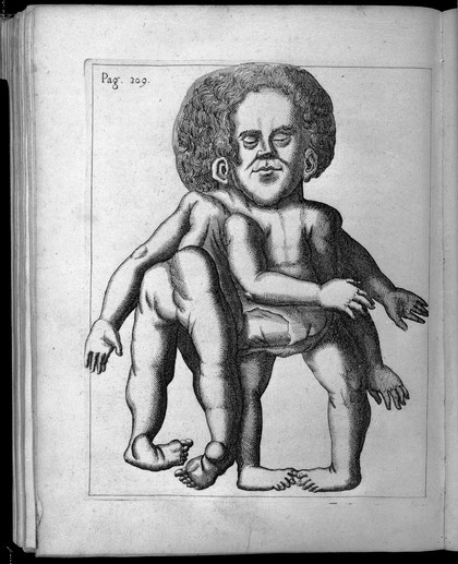 A Siamese Twin