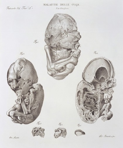 Diseases of the ovary - petrified foetus