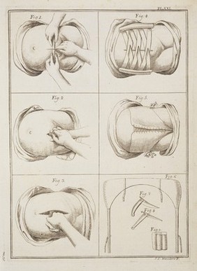 Illustrations relating to cesarean operation.