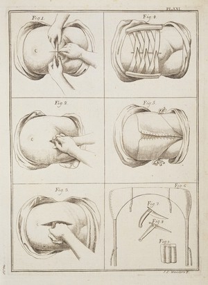 view Illustrations relating to cesarean operation.