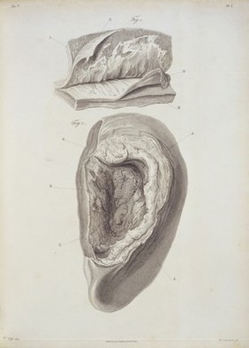 Inflammation of the capsule of the liver, with abscess.