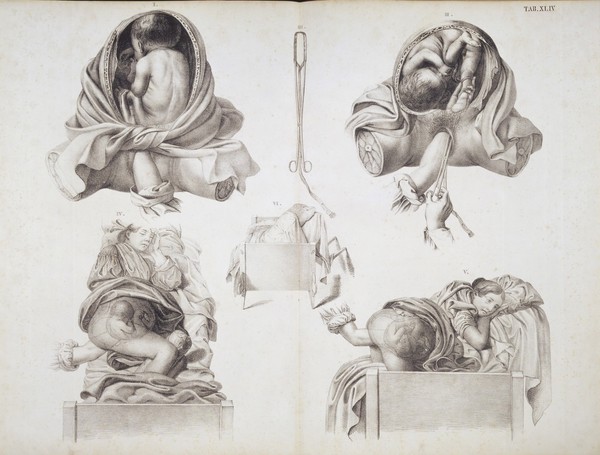 Obstetrics: Breech presentation