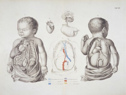 View of internal organs of of infant, 