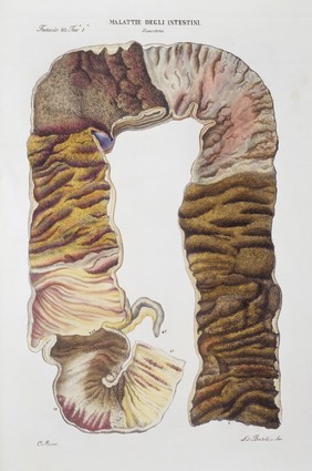 Diseases of the intestine