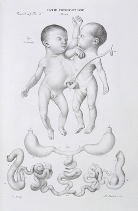 Abnormalities: Conjoined twins