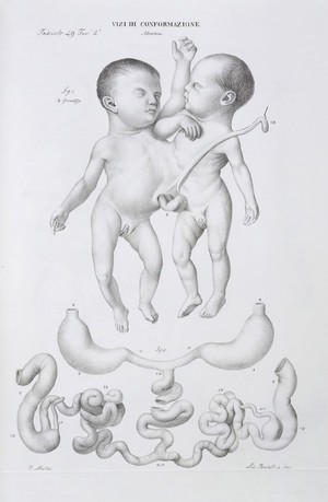 view Abnormalities: Conjoined twins