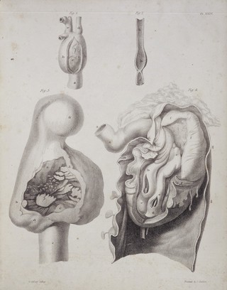 Two aneurisms: fig. 1 of crural , fig. 2 of carotid artery