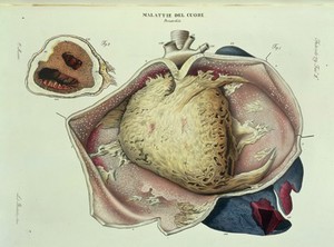 view Diseases of the heart