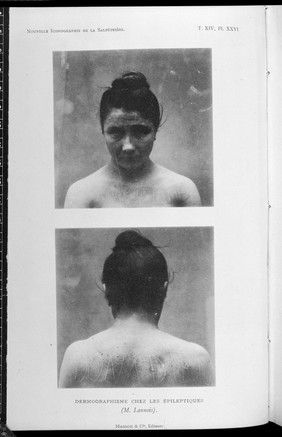 Female patient of the Salpetriere with marking on her front