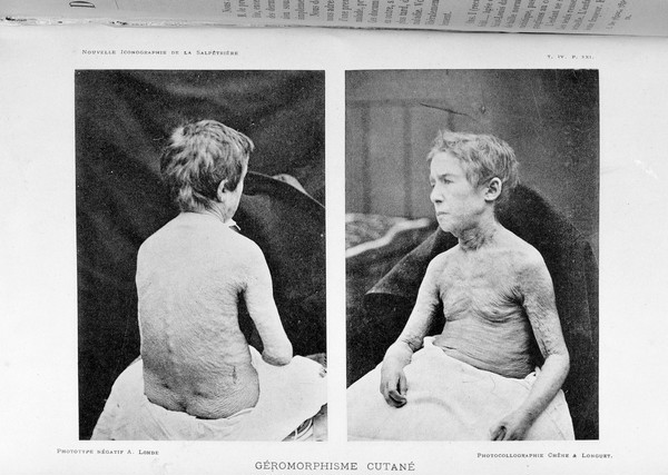 Child patient of the Salpetriere with aged skin