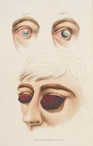 view Diagrams of ophthalmia, inflammation of the eye