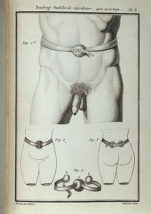 view Diagram of a Hernia bandage on male & female subject