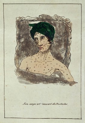 Hand-coloured engraving: son corps est couvert de pustules.