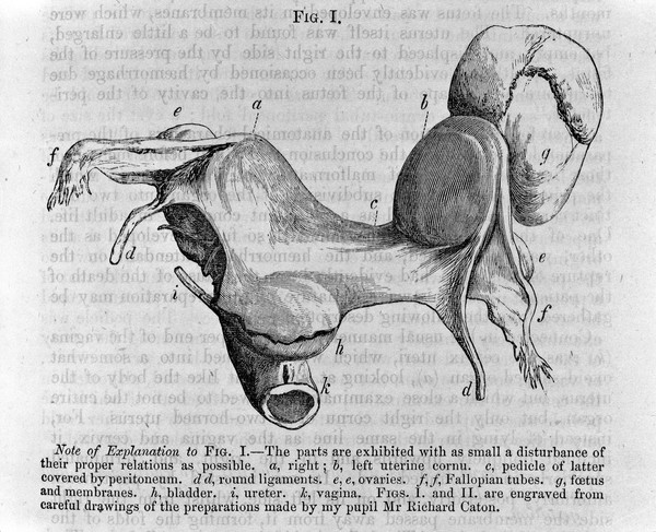 A congenital malformation of th uterus