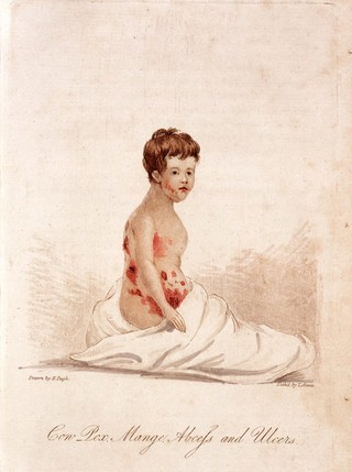 A girl with Cow-Pox mange, abscess and ulcers