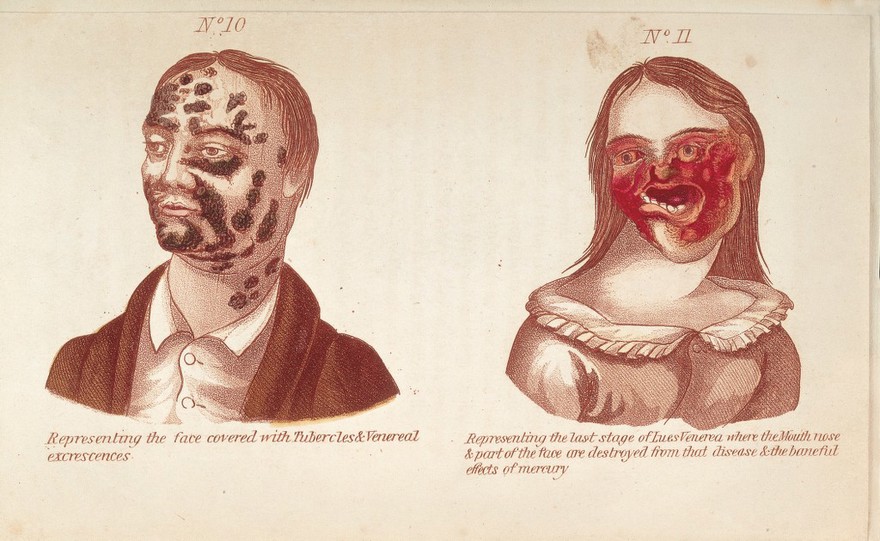 The secret companion, a medical work on onanism ... and on venereal and syphilitic diseases ... followed by observations on marriage.