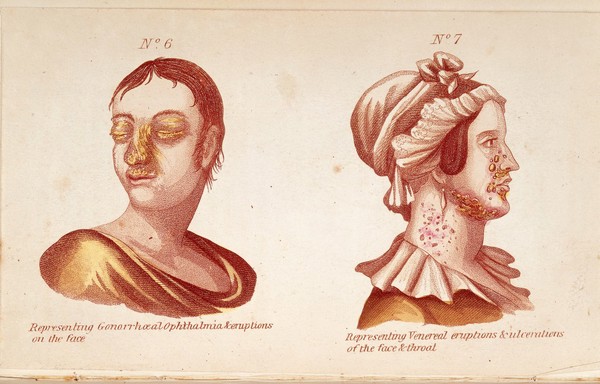 (Left) Representing Gonnorrheal Ophthalmia & eruptions on the face. (Right) Representing Veneral eruptions & ulcerations on the face & throat