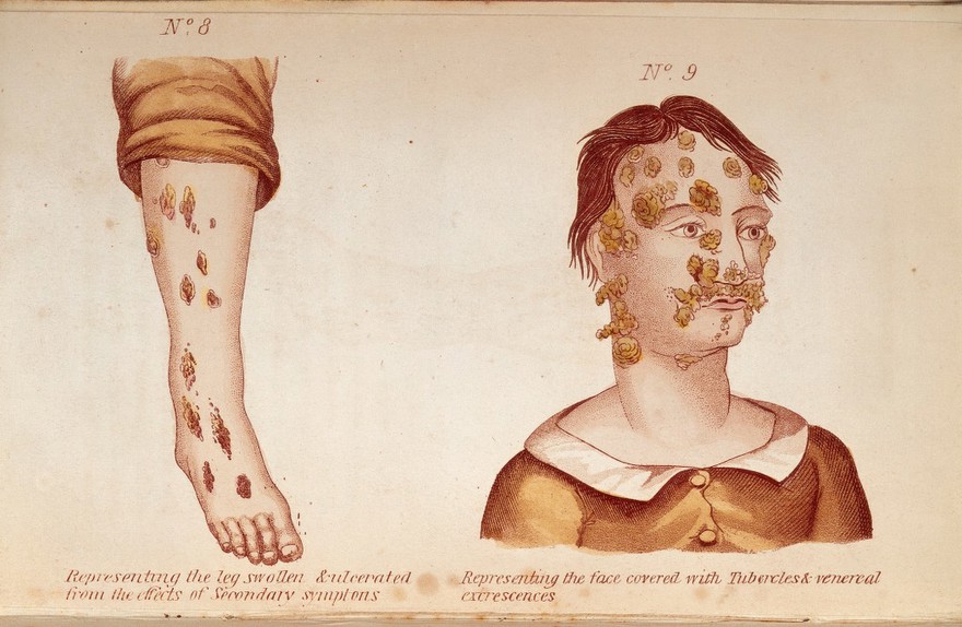 (Left) Representing the leg swollen and ulcerated from the effects of Secondary symptoms. (Right) Representing the face covered with Tubercles & veneral excrescences