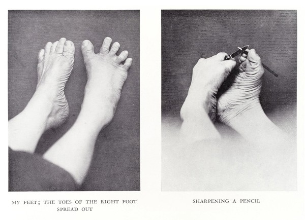 The feet of C. H. Unthan, the armless fiddler. (R) My Feet: The toes of the right foot speard out, (L) Sharpening A Pencil