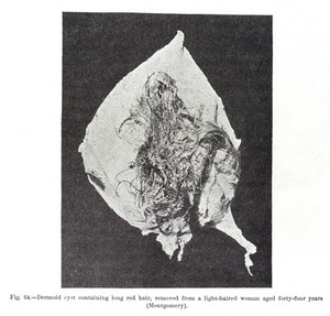 view Dermoid cyst containing long red hair, removed from a light-haired woman aged forty-four years (Montgomery)