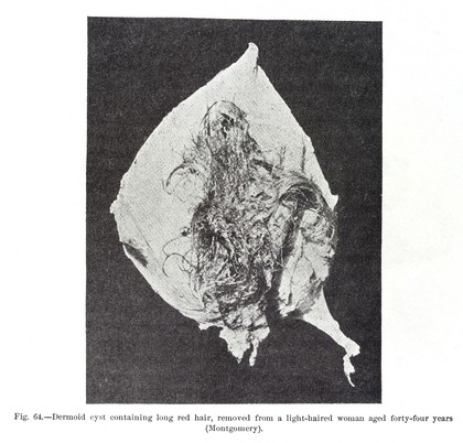 Dermoid cyst containing long red hair, removed from a light-haired woman aged forty-four years (Montgomery)