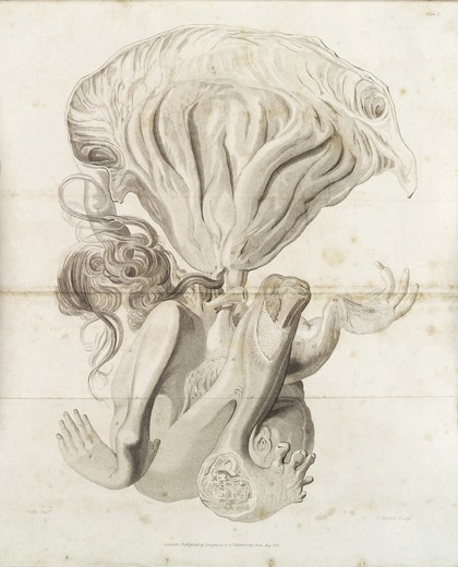 Foetus in a young man
