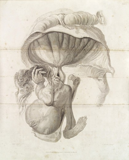 Foetus in a young man