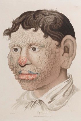 Delineations of cutaneous diseases: exhibiting the characteristic appearances of the principal genera and species comprised in the classification of the late Dr. Willan; and completing the series of engravings begun by that author / [Thomas Bateman].