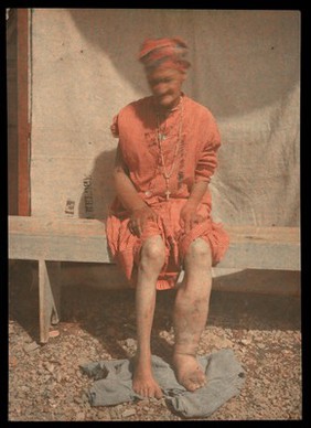 Victim of elephantiasis. Glass positive, ca. 1919.